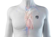 3D rendered illustration of a man with a pacemaker
