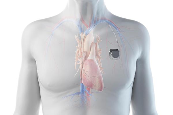 3D rendered illustration of a man with a pacemaker